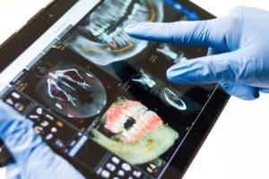 Dental Fillings