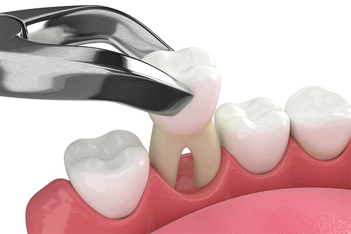 Illustration of tooth being removed with forceps