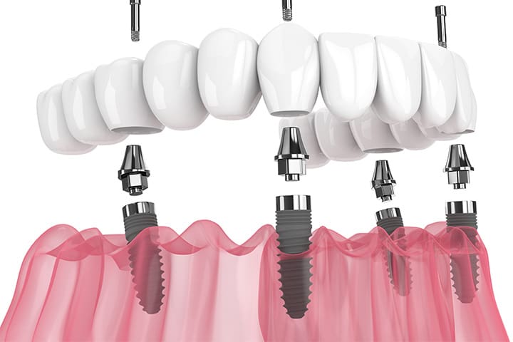 Digital image of implant denture