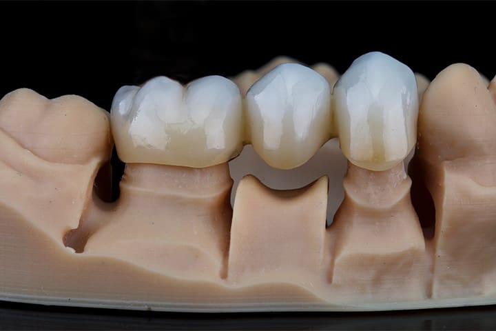 A dental bridge.