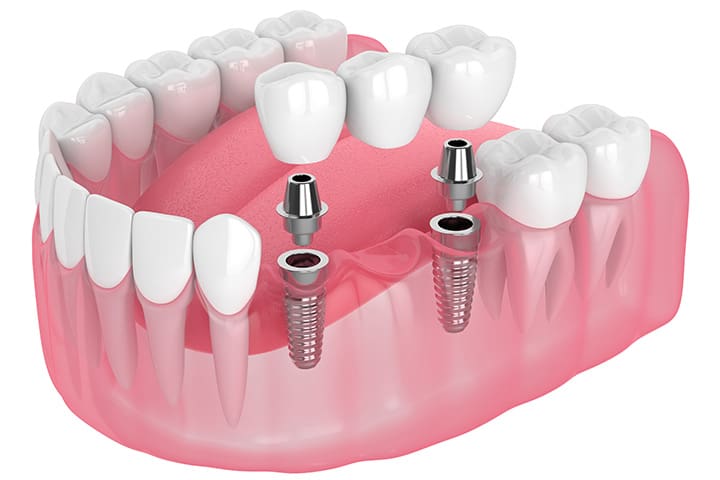 A digital model of an implant bridge.