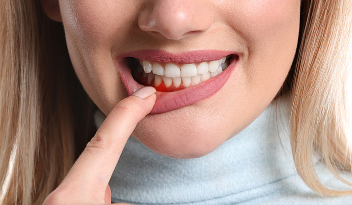 Blonde woman pulling down lip to show gum disease in Northampton.