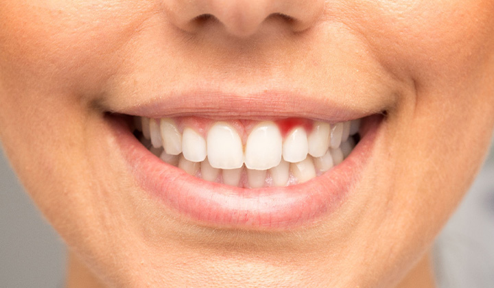Close-up of person’s smile with signs of gum disease.