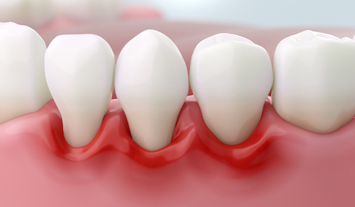 Illustration of inflamed gum tissue around teeth.