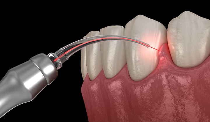Illustration of laser being used to treat gums.