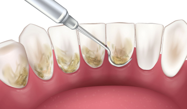 Illustration of scaling and root planing performed on back of teeth.