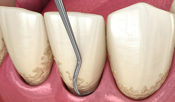 Illustration of scaling and root planing performed on lower teeth.