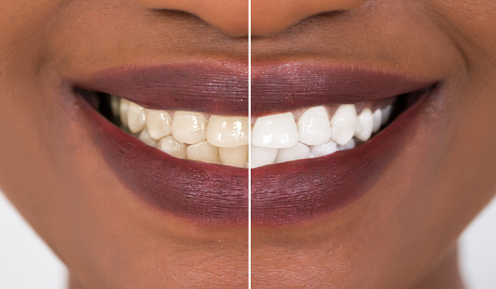 Patient's smile before and after teeth whitening.