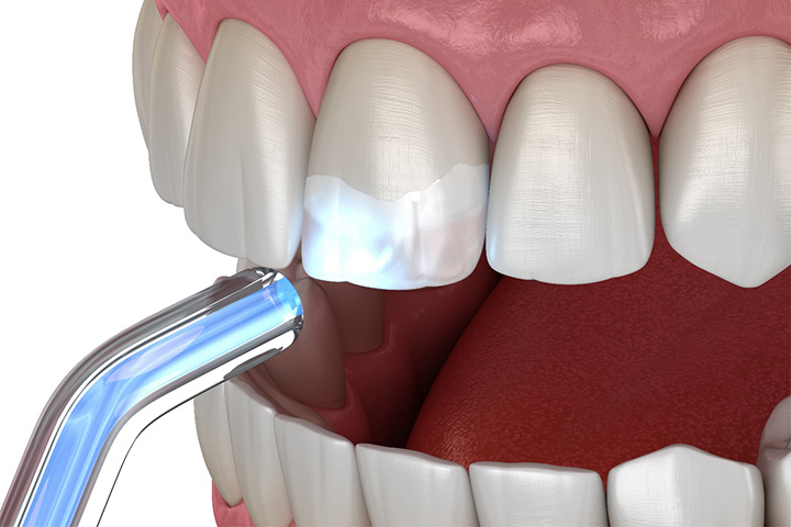 Digital image of dental bonding.