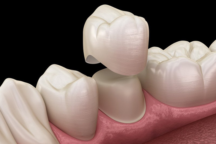 Exploded illustration of dental crown and treated tooth.