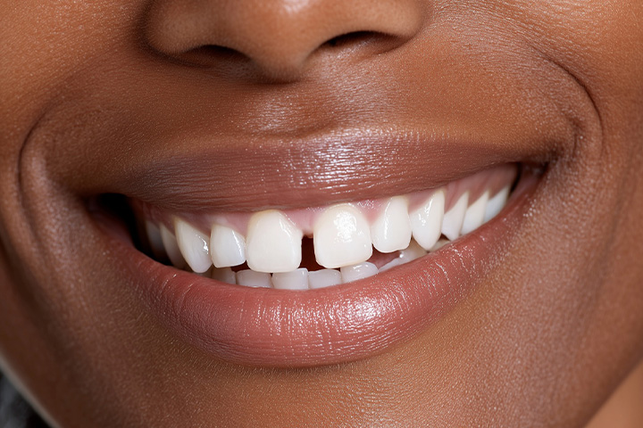 Person with a small gap between their two front teeth.