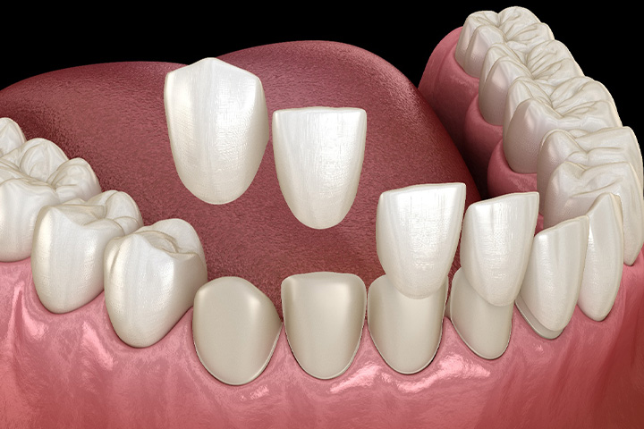 Up-close view of dental veneers.